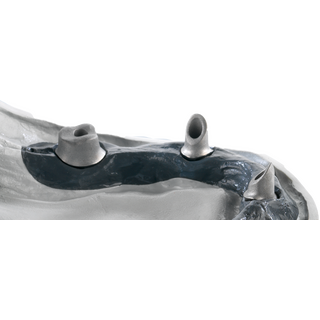 Titanabutment inkl. Implantatschraube STL-Datensatz